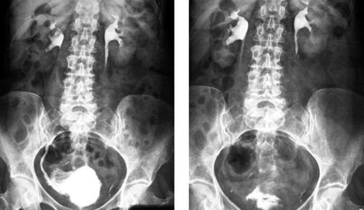 Urografia per la diagnosi della prostatite